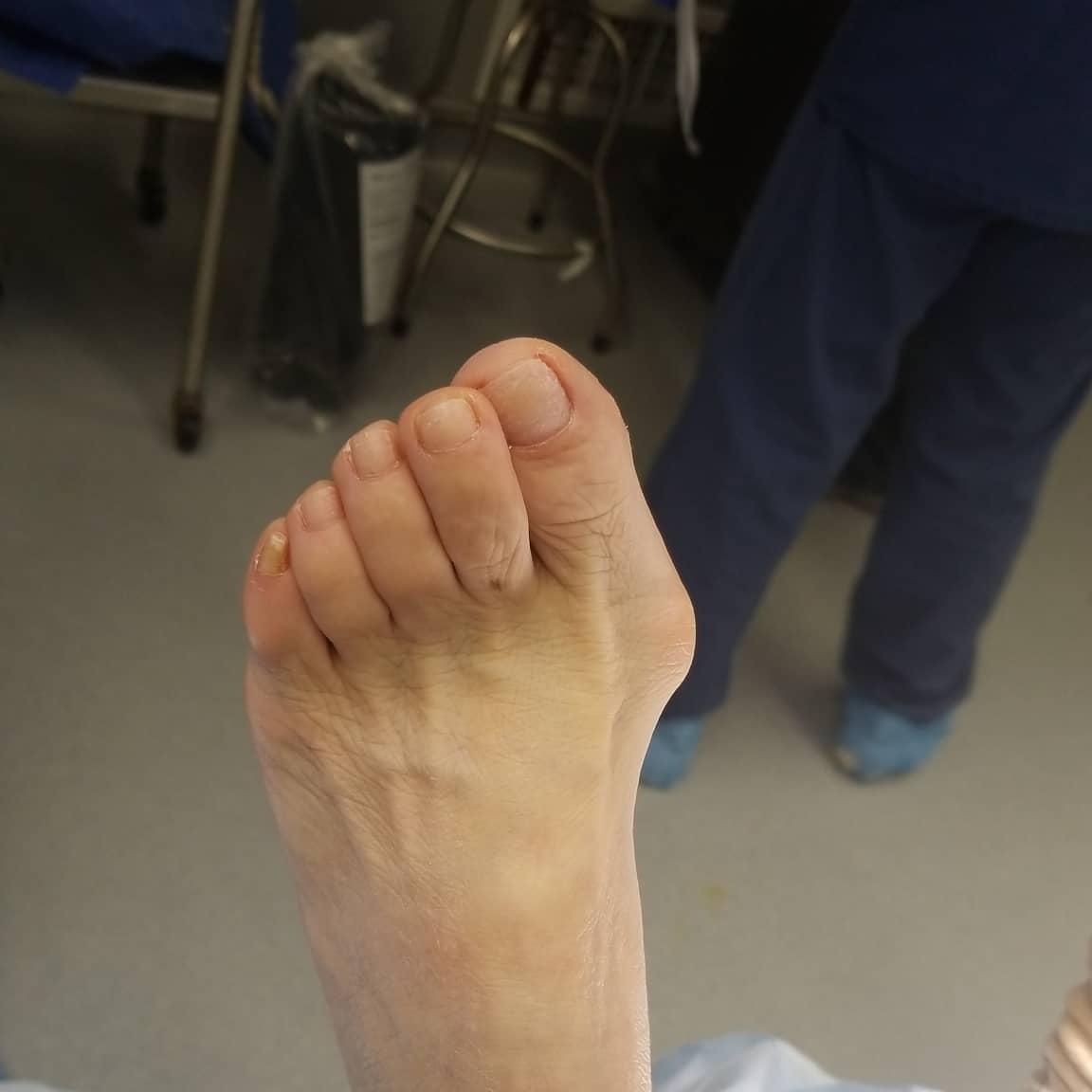 Bunion  Surgery 