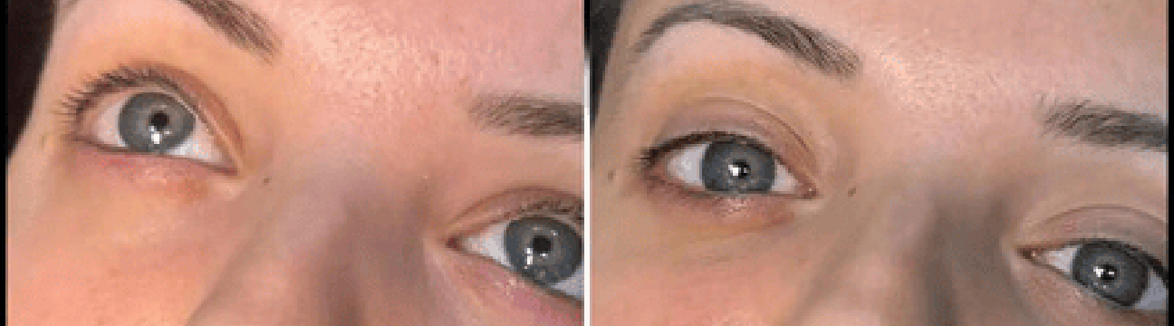 Dermal Fillers
