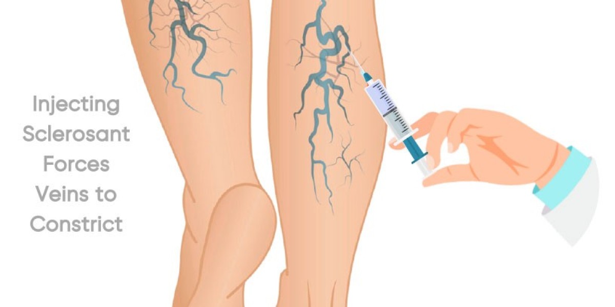 How to Choose the Right Varicose Veins Treatment for You