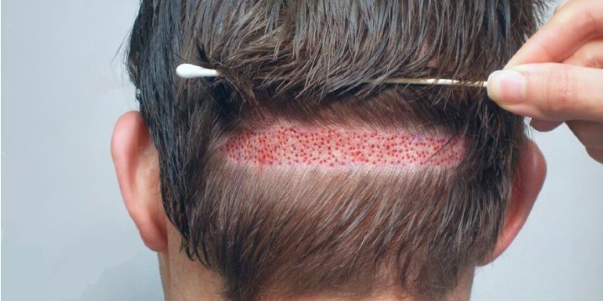 Hair Transplant in Pakistan – Expert Tips for Long-Lasting Results