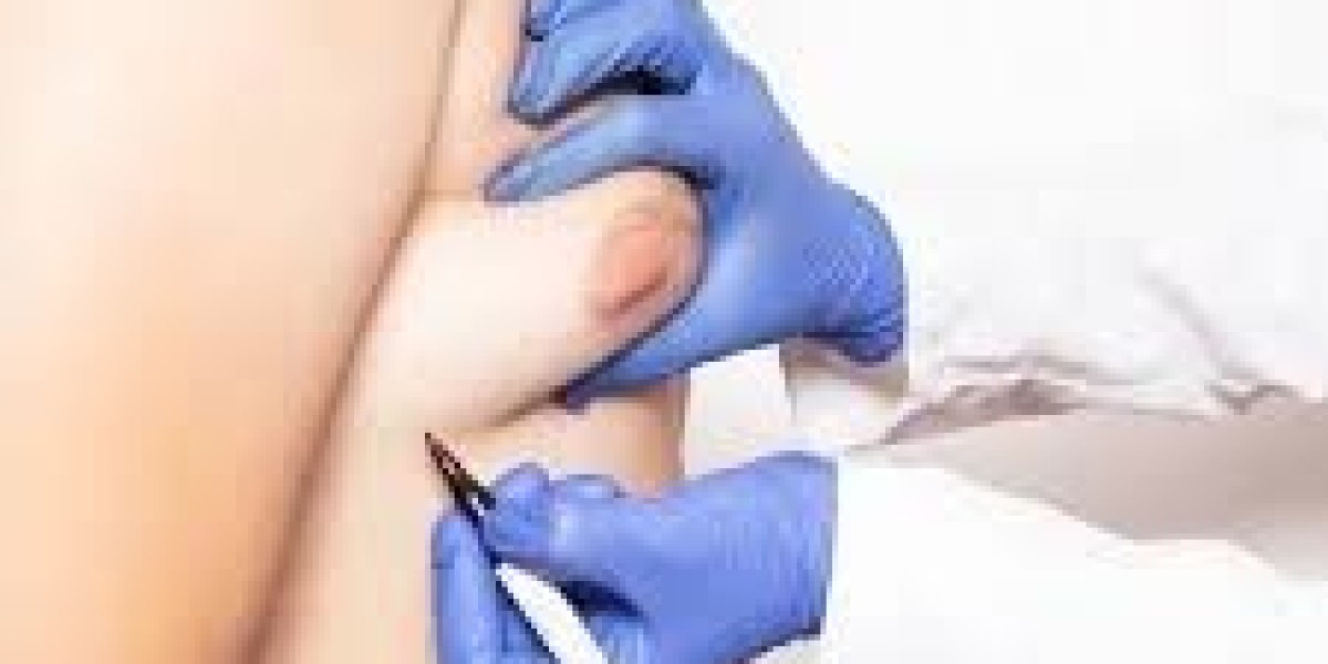 Navigating Gynecomastia Treatment in Islamabad: Expert Advice and Resources