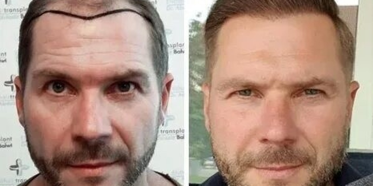 Hair Transplant in Islamabad – A Modern Solution for Hair Loss