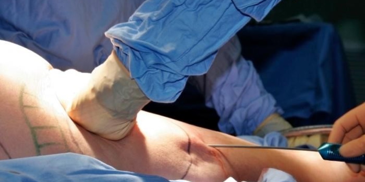 Liposuction in Islamabad – Precision Body Sculpting
