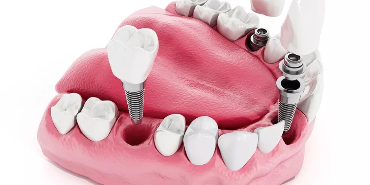 Dental Implants in Islamabad – The Modern Tooth Replacement Solution