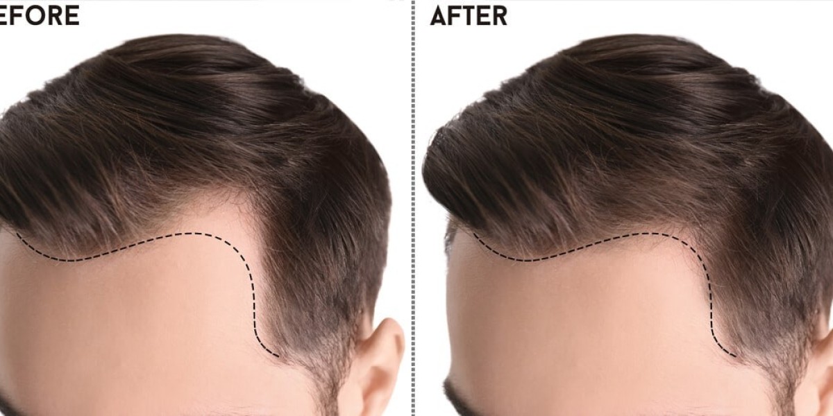 Unlocking Excellence: A Comprehensive Guide to Hair Transplants in Pakistan