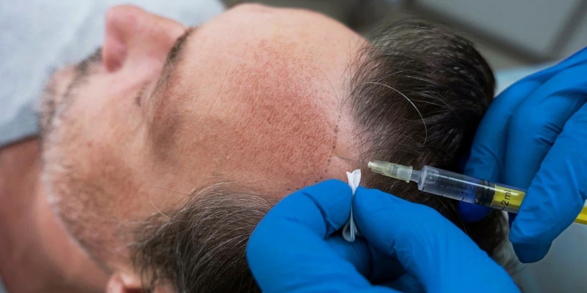 The Science Behind Hair Transplant in Islamabad