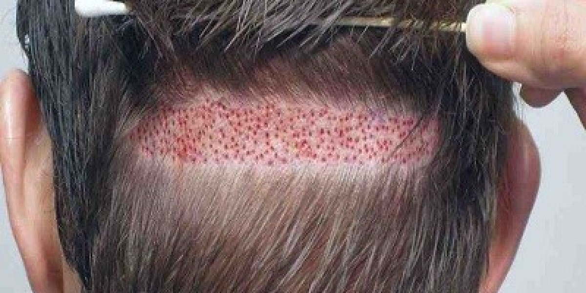 Cost of 4000 Grafts Hair Transplant in Riyadh