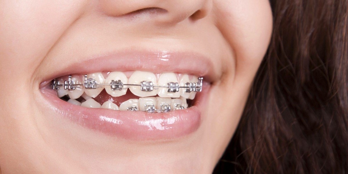 Transform Your Smile With Customized Dental Braces Treatment