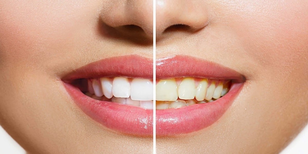 The Ultimate Guide to Modern Teeth Whitening in Dubai: Achieve a Brighter Smile Safely