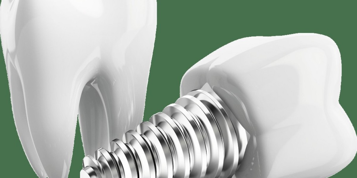 Discover Why Choosing a Dental Implants Clinic in F7 Is a Smart Tooth Replacement Decision