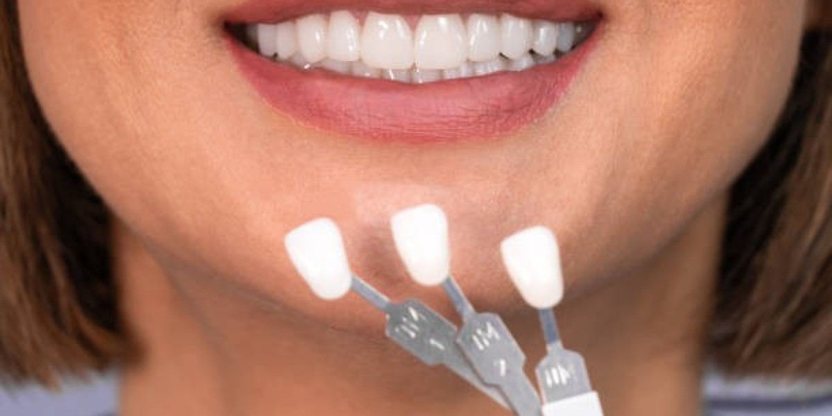 Elevate Your Smile with Premium Dental Veneers in Islamabad