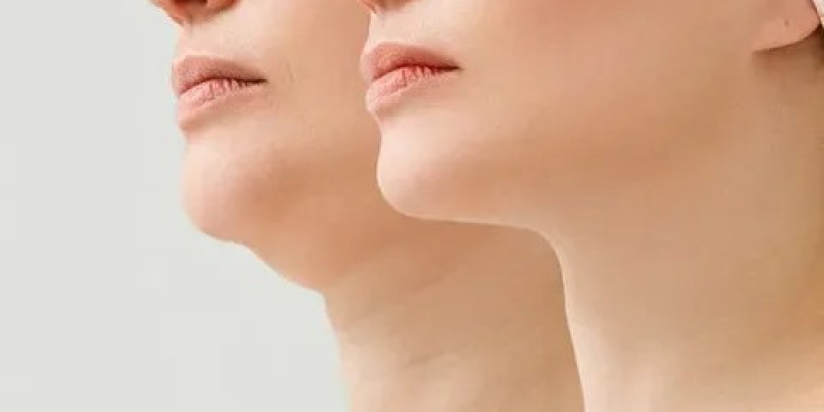 Best Double Chin Tightening in Islamabad