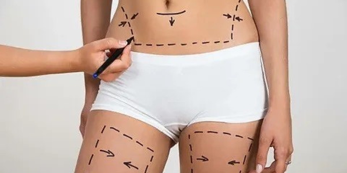 How Liposuction Helps in Body Contouring in Islamabad