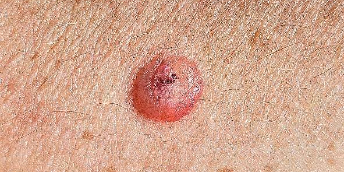 بعد عملية إزالة الشامة: نصائح للعناية بالجلد والشفاء السريع