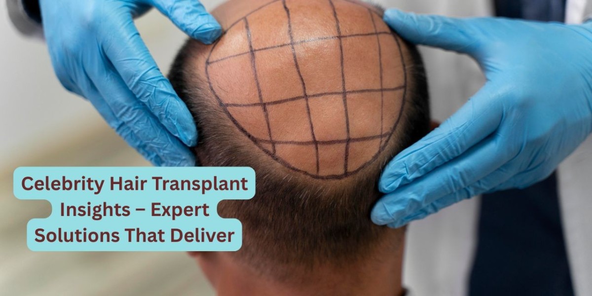Celebrity Hair Transplant Insights – Expert Solutions That Deliver