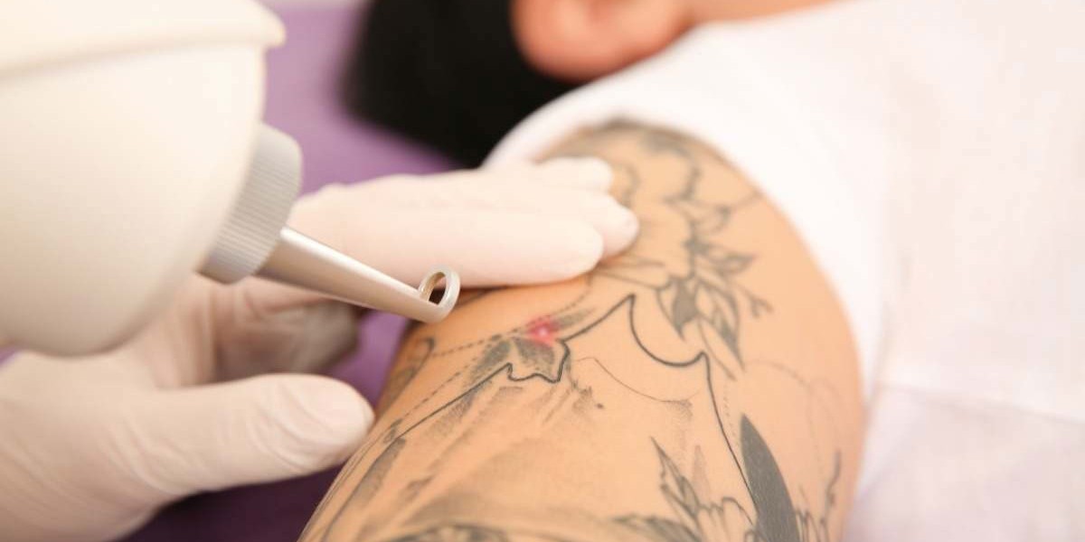 إزالة الوشم بأمان للرجال والنساء في الرياض
