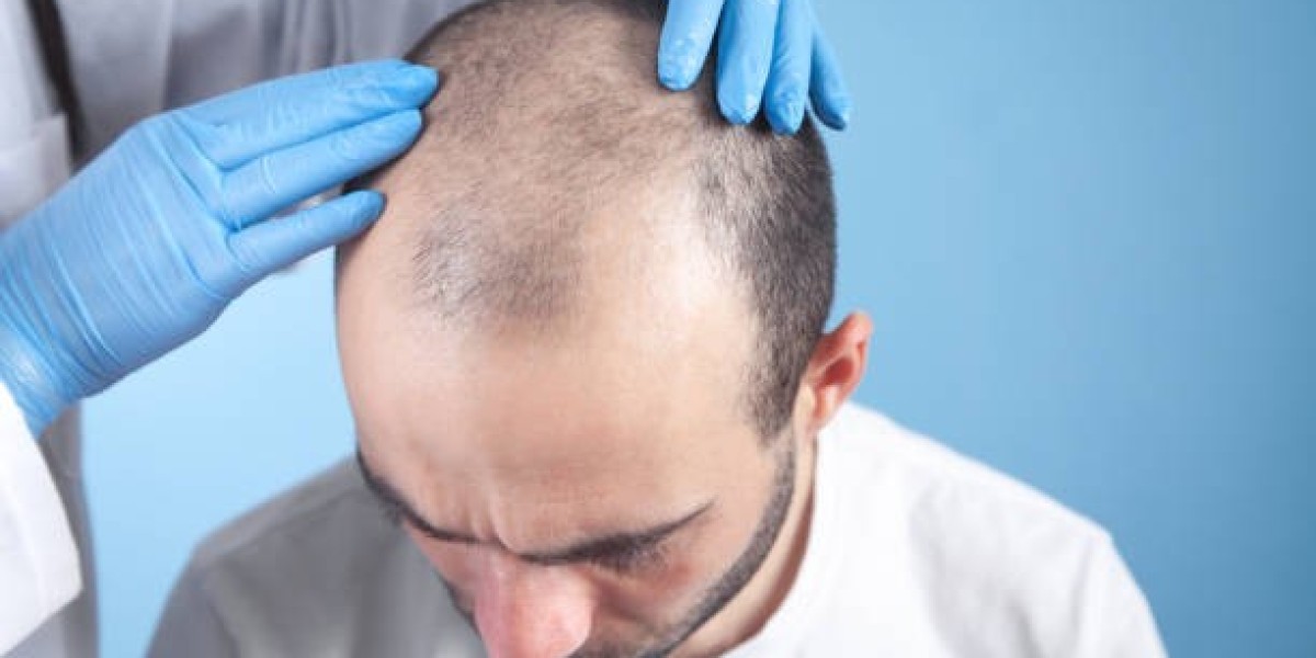 Hair Transplant in Dubai: How Long Do the Results Last?