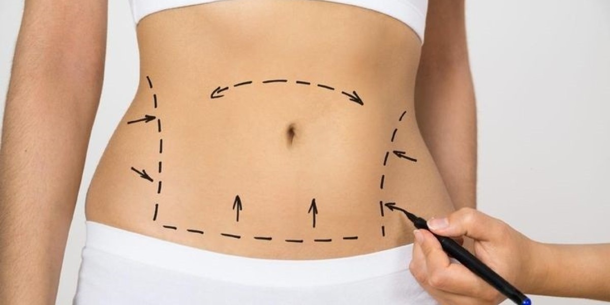 Liposuction Procedure: How to Achieve Best Results