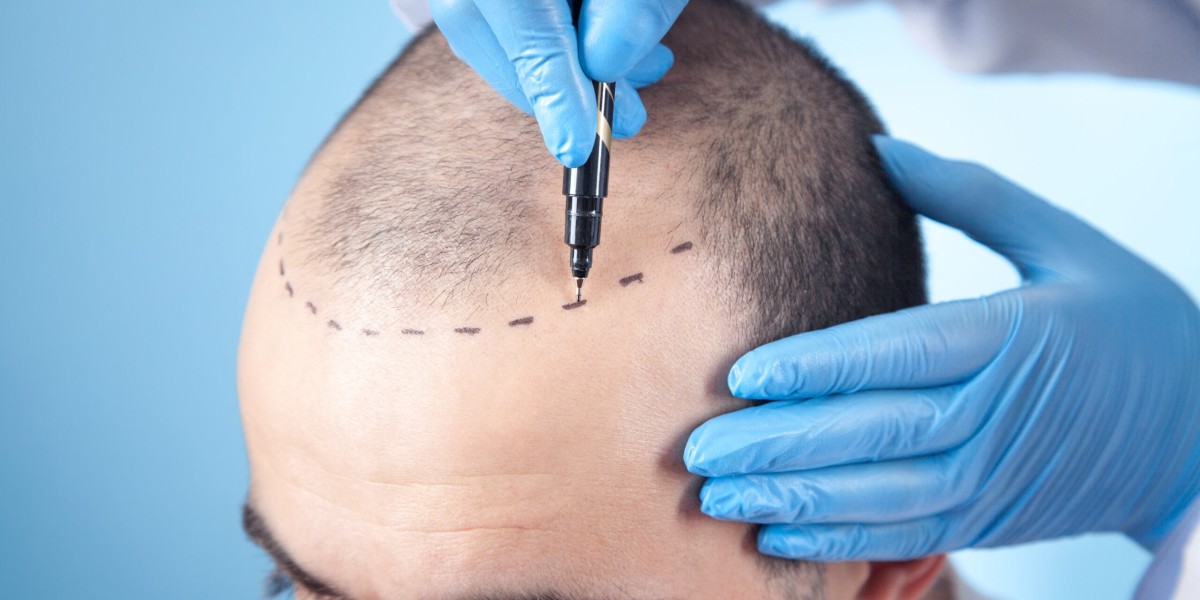 أفضل عيادات زراعة الشعر الرجالية في بريدة