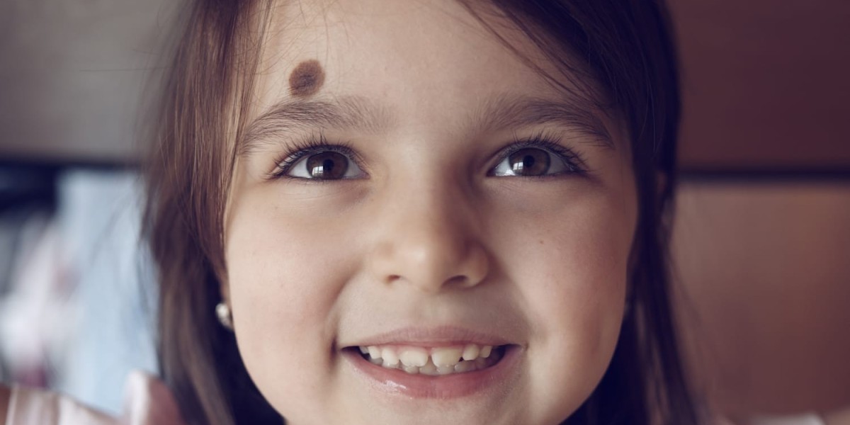 How Does Birthmark Removal Work on Darker Skin Tones?