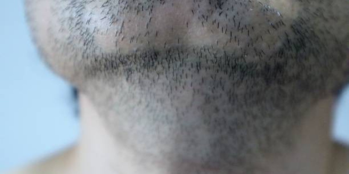 Beard Hair Transplant in Dubai: Why More Men Are Choosing It