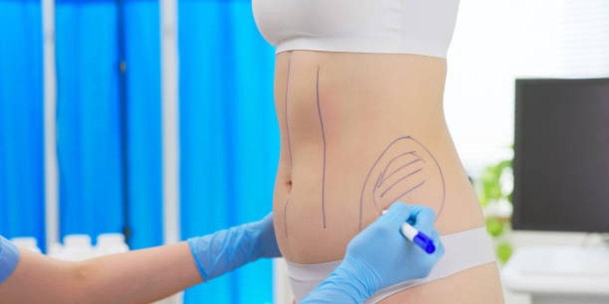 Who Is the Ideal Candidate for Liposuction Procedures?