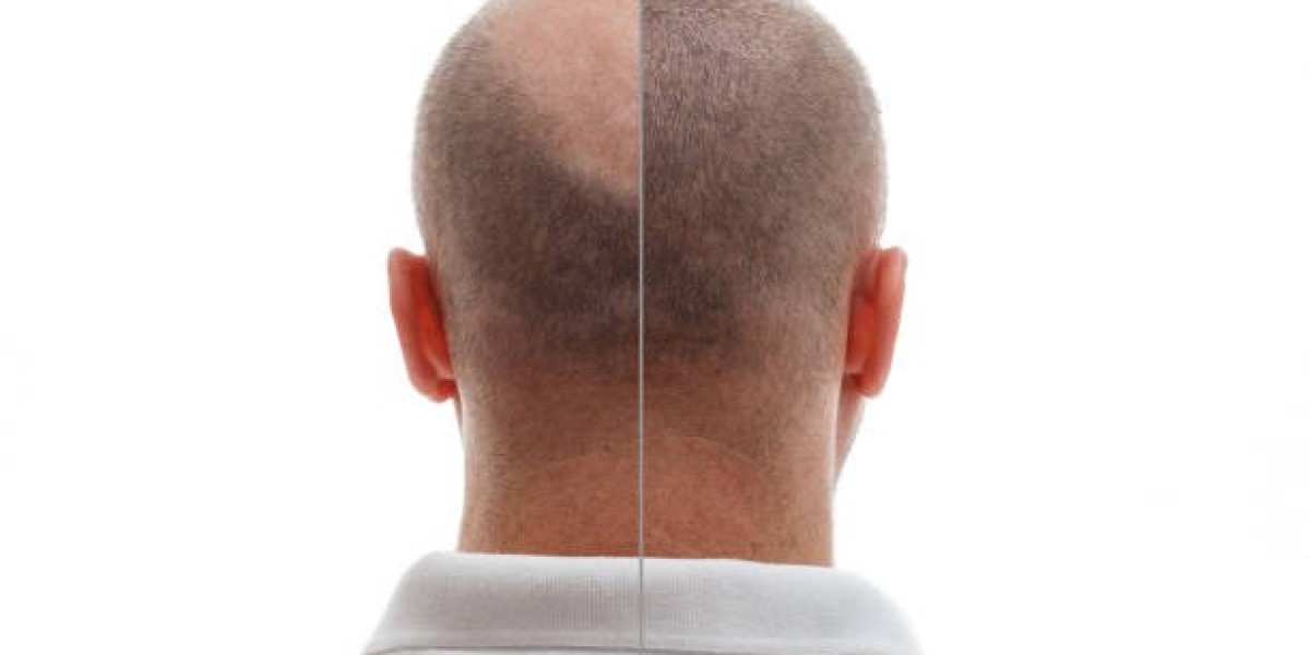 Hair Transplant in Riyadh: Expert Advice