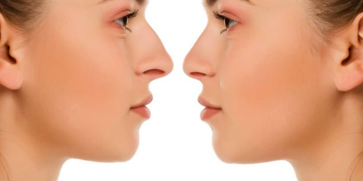 Rhinoplasty for Droopy Tip Nose Lift Solution