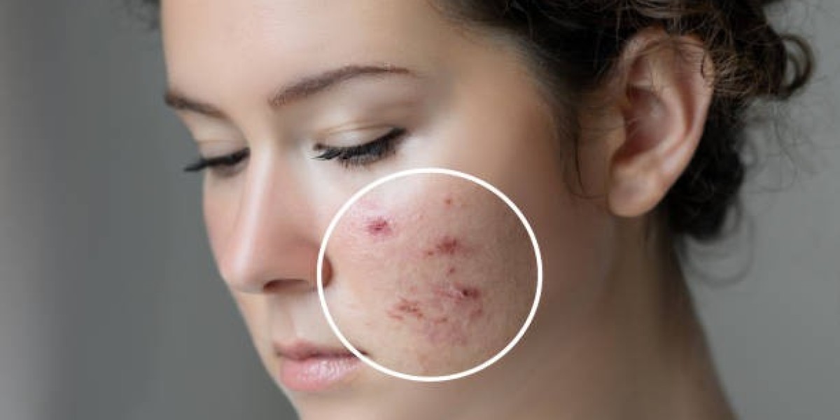 Boost Collagen with Laser Acne Procedures