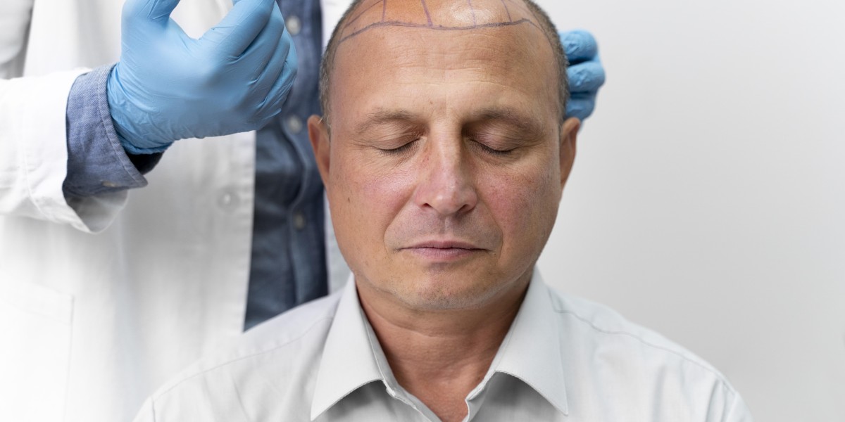 Hair Transplant in Dubai: What to Expect Before, During & After the Procedure