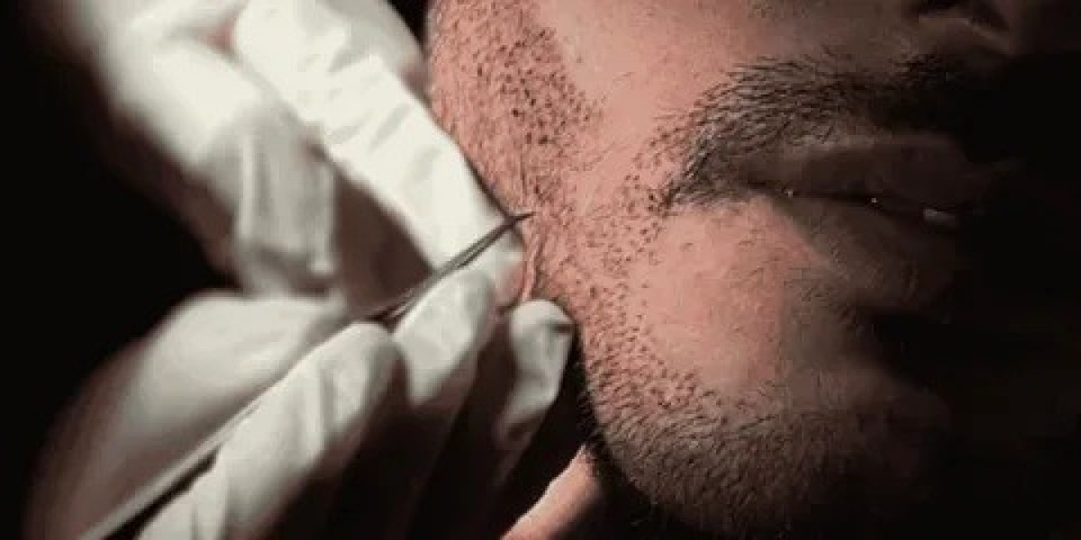 How Do You Prepare for a Beard Hair Transplant in Islamabad?