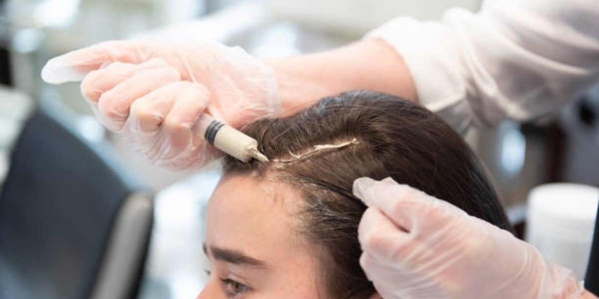 PRP Hair Treatment Accelerates Hair Regrowth Phase