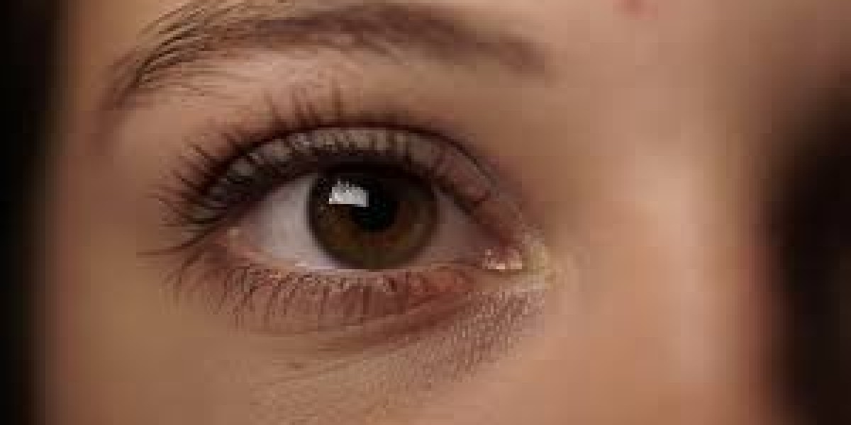 Home Remedies vs. Professional Treatments for Dark Circles in Riyadh
