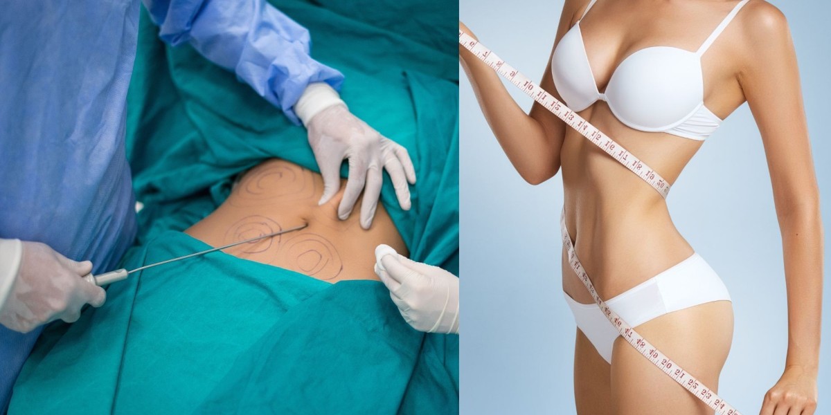 متى تكون مرشحًا لشفط الدهون في الرياض