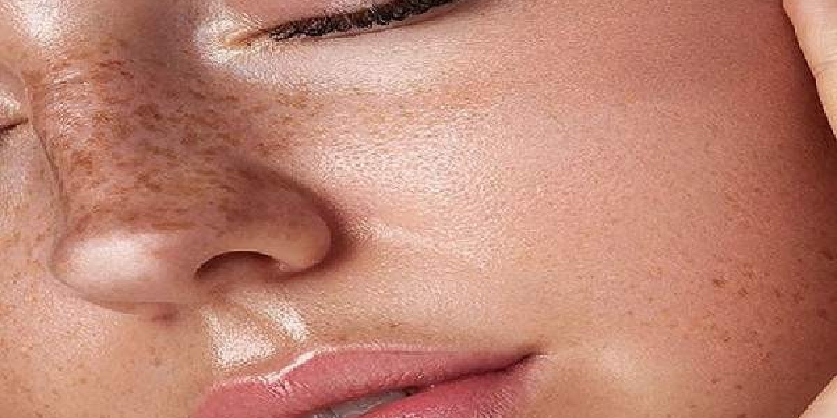 Guaranteed Melasma Treatment in Islamabad with Advanced Care