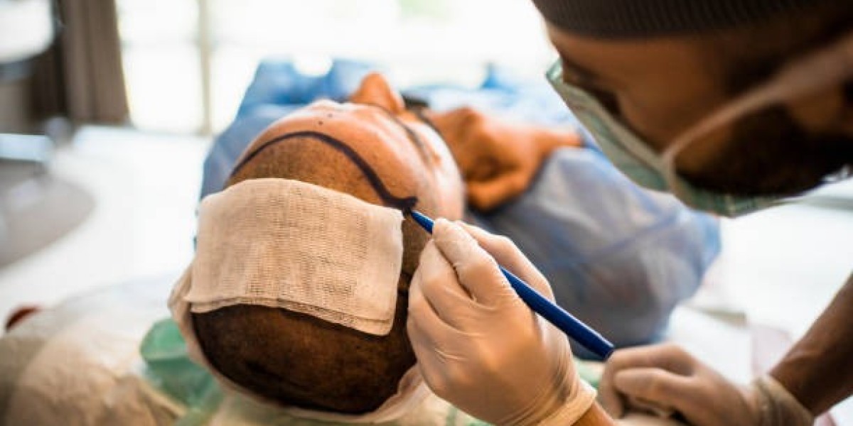 Hair Transplant Cost: Everything First-Time Patients Ask
