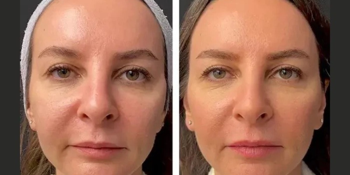 “Best Dubai Aesthetic Clinics for Mesotherapy Skin Glow Treatment”