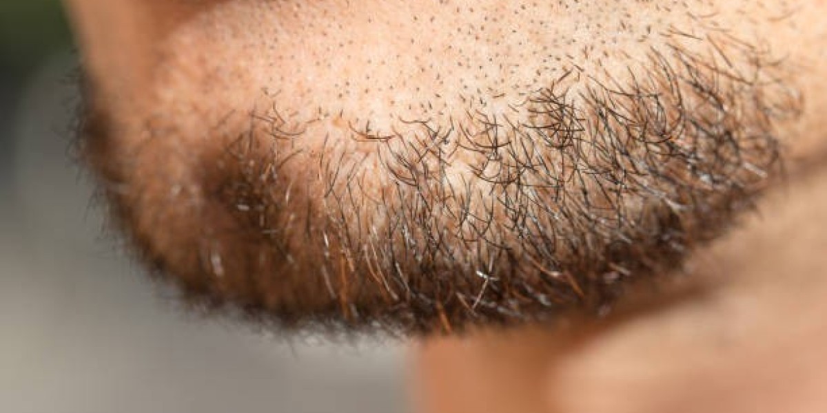 Beard Hair Transplant in Dubai: Restore Confidence with a Fuller Beard