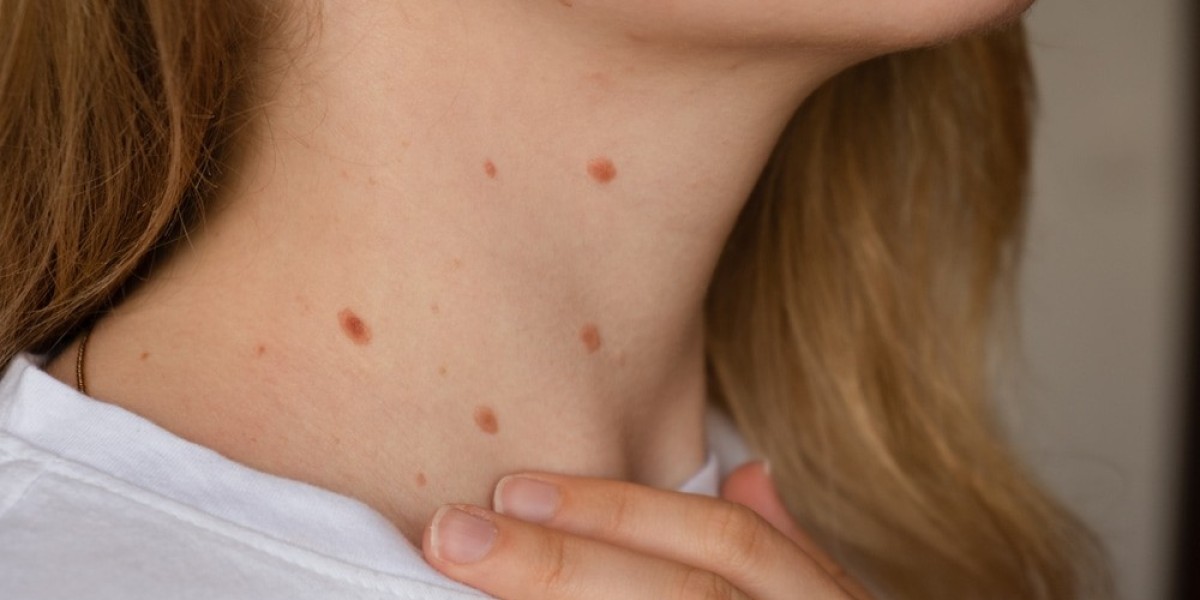 Can You Pass Them On? Understanding Are Skin Tags Contagious