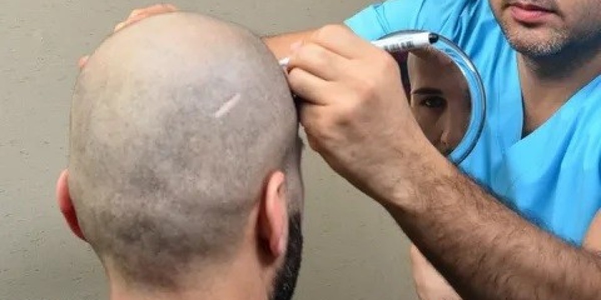 Hair Transplant in Riyadh: A Modern Approach to Permanent Hair Restoration