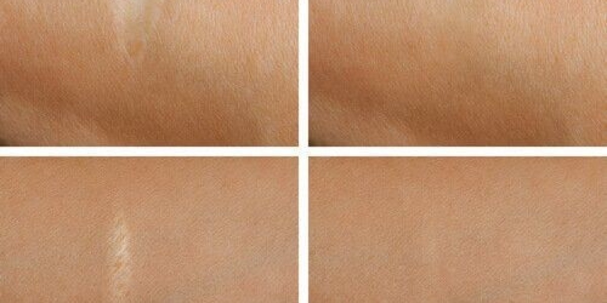 Laser Scar Removal: Non-Invasive Treatments That Work