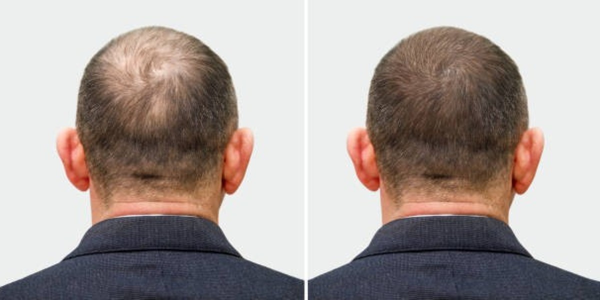 FUE Hair Transplant Pros and Cons