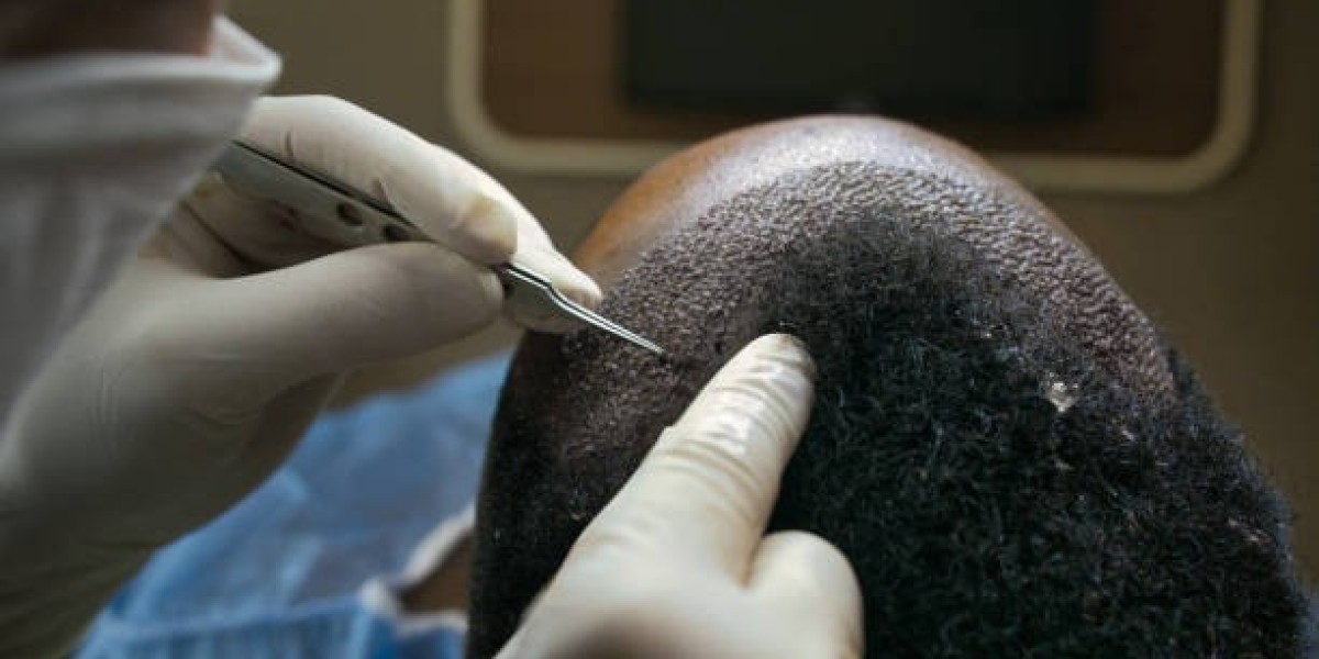 Hair Transplant in Dubai: Post-Procedure Care and Maintenance