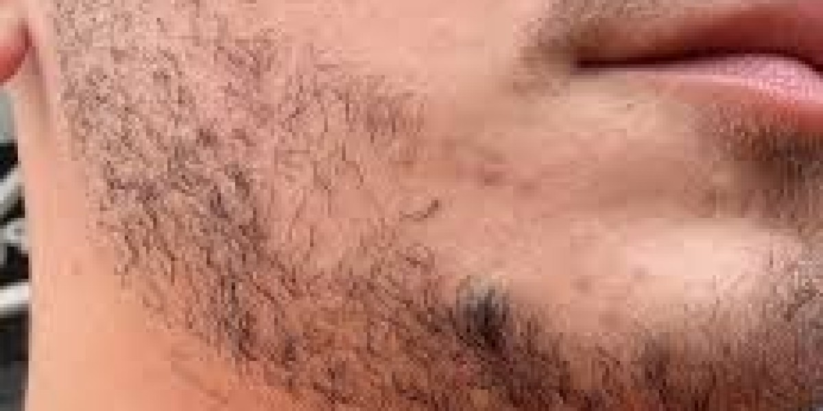 Beard Hair Transplant for Men With No Beard Growth