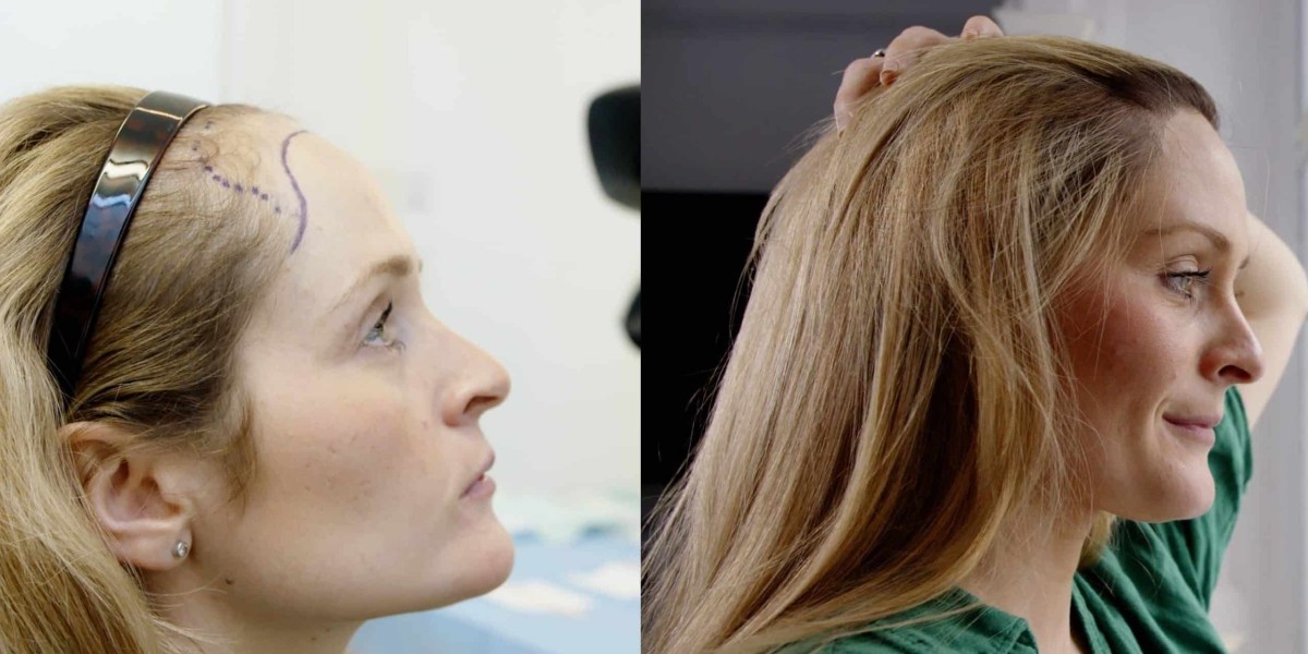 Hair Loss Solutions That Don’t Involve Surgery