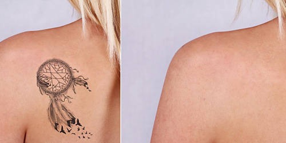 Laser Tattoo Removal Explained for Safe and Clear Skin