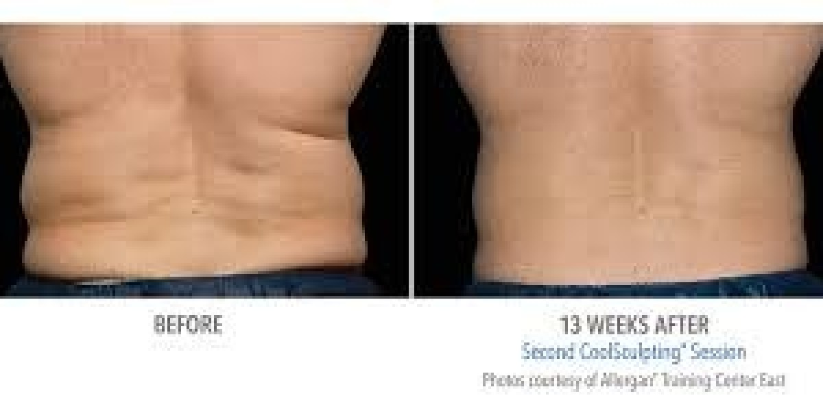 Fat Reduction Ottawa: Proven Non-Surgical Treatments and Clinic Guide