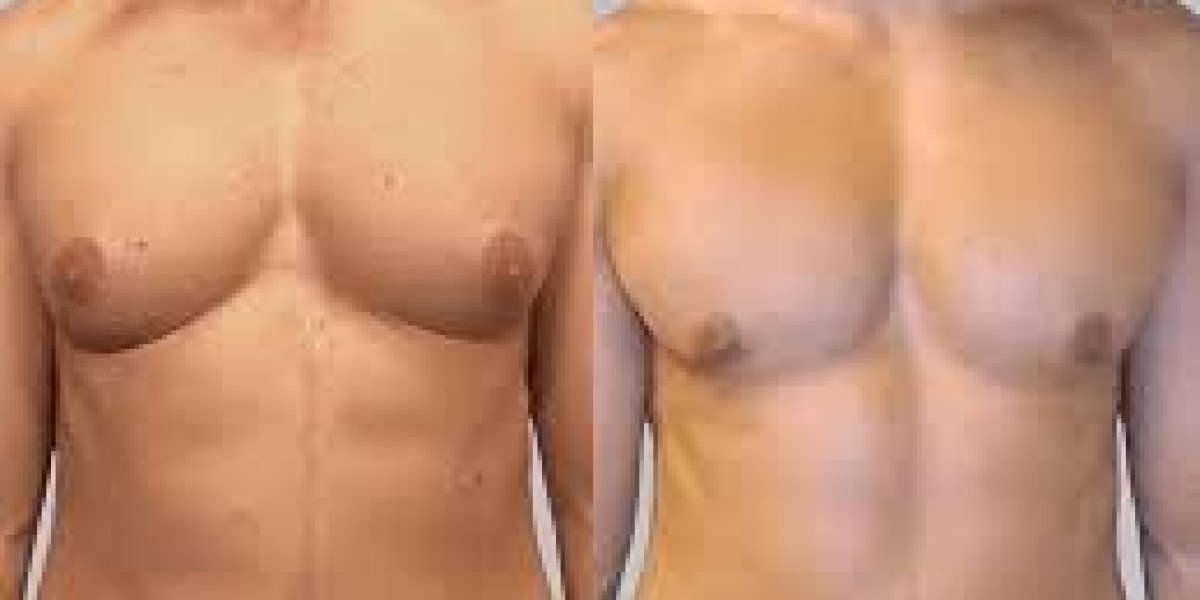 Local Tips for Recovering from Gynecomastia Surgery in Islamabad: Which Works Better