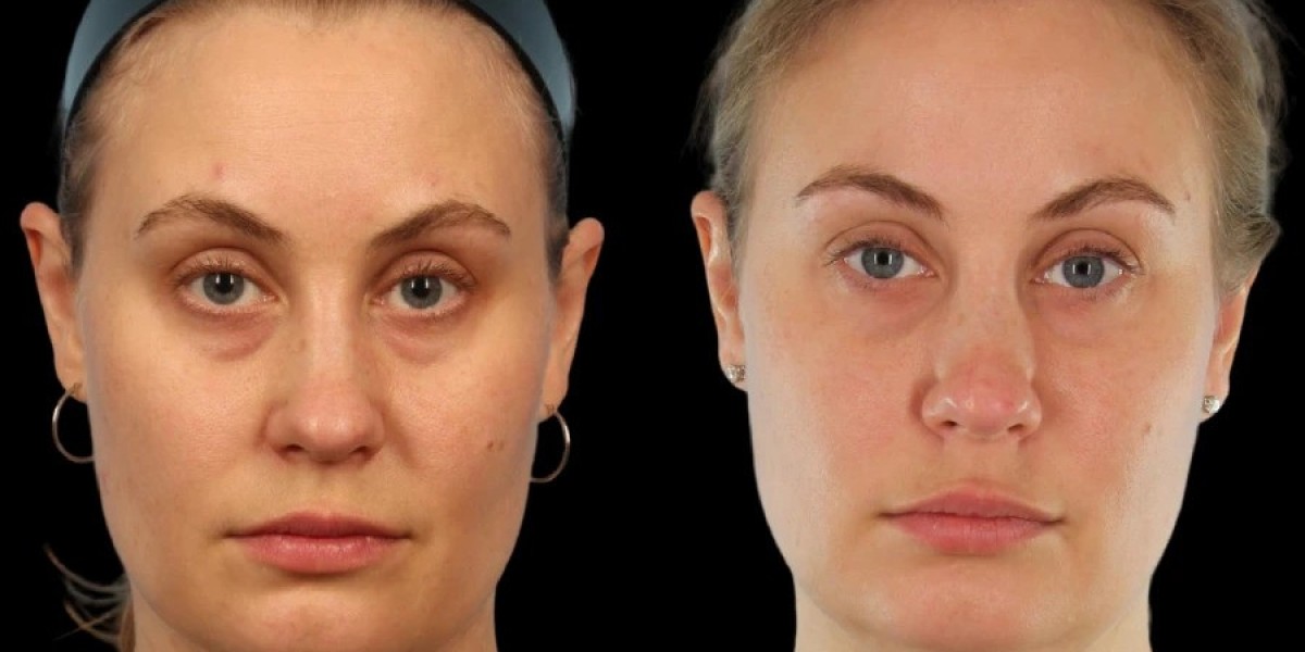 Under Eye Fillers in Dubai for Natural Eye Shape