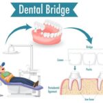 Dental Bridges Explained: Why Experience of the Dentist Is Key - Tumblrblog